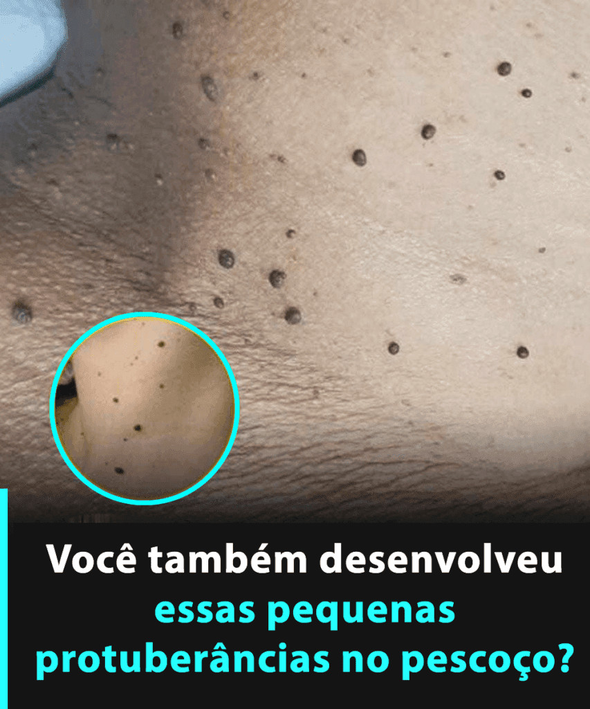 Se você notou esses pequenos pedaços de pele no pescoço ou nas axilas, pode ser que…