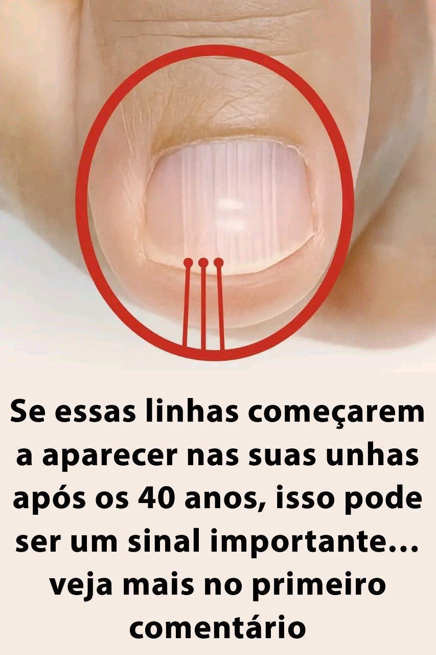Se linhas começarem a aparecer nas suas unhas depois dos 40 anos, isso pode ser um sinal de alerta…