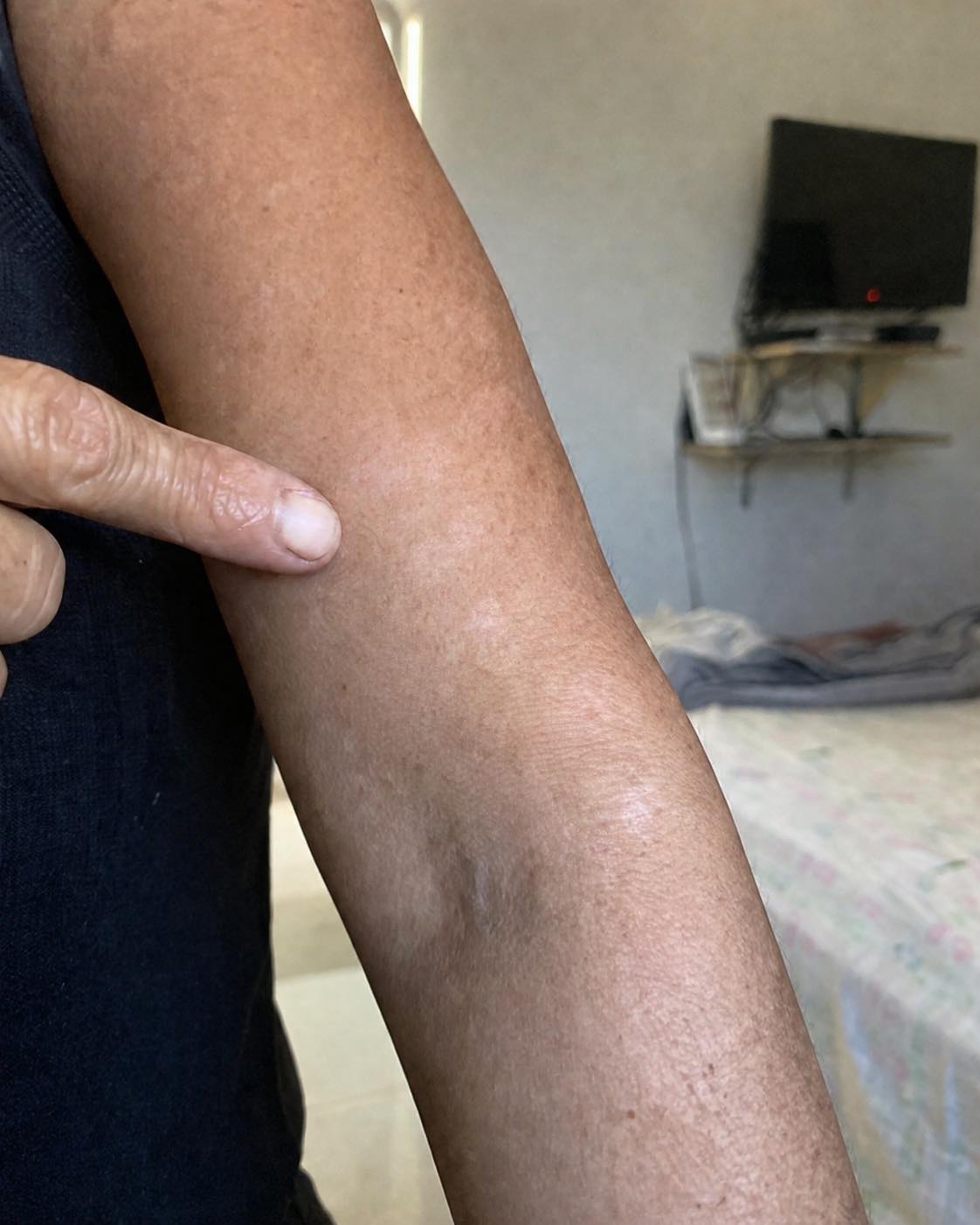 O que pode estar por trás das manchas brancas na pele? Veja as possíveis causas