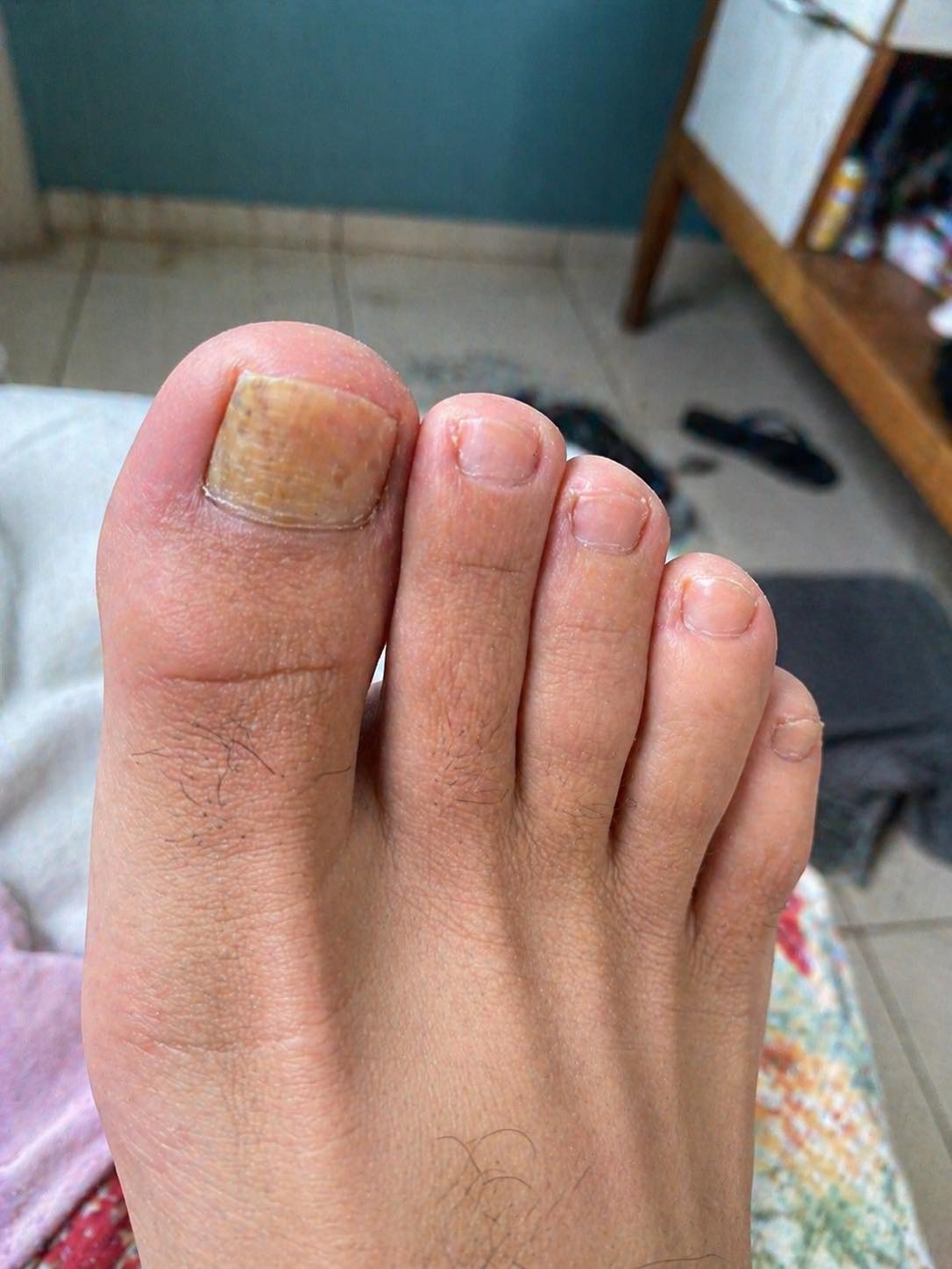 Diga adeus ao fungo nas unhas com este remédio natural simples