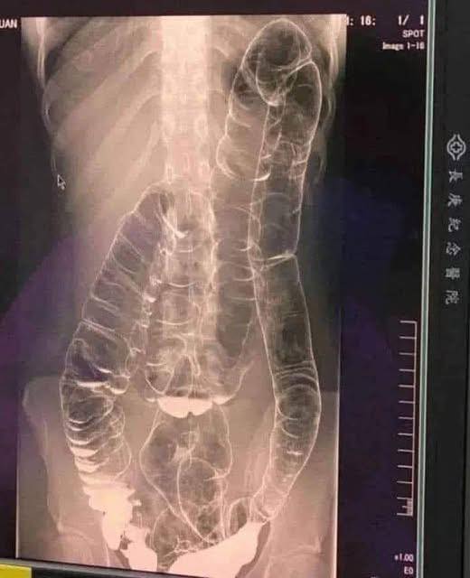 Cólon saturado: quando o corpo dá sinais de alerta