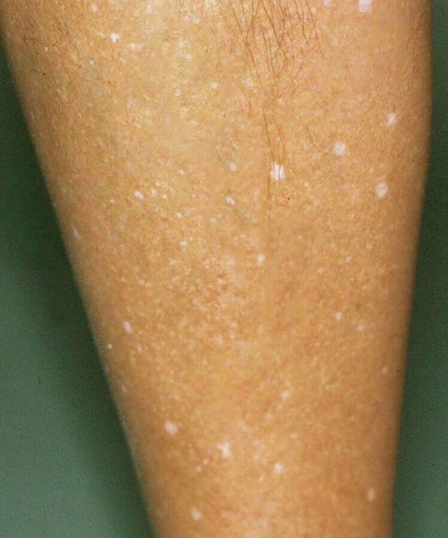 O que pode estar por trás das manchas brancas na pele? Veja as possíveis causas