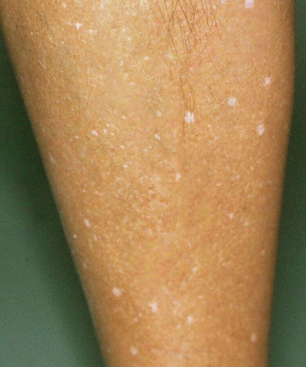 O que pode estar por trás das manchas brancas na pele? Veja as possíveis causas