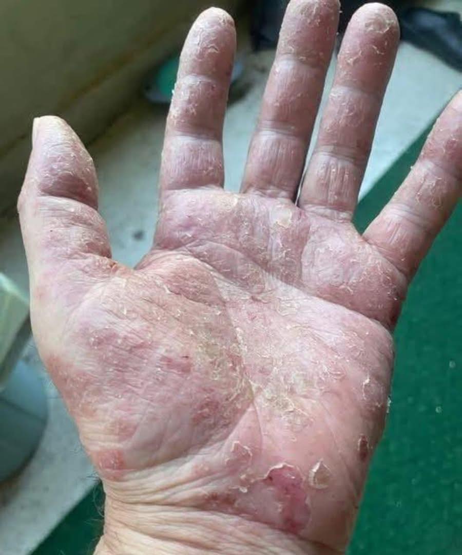 Se aparecer isso nas suas mãos, cuidado! Saiba por que você não pode ignorar esses sinais
